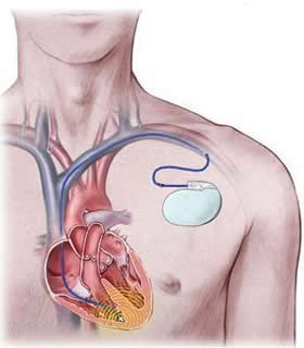 Muster eines Defibrillators (ICD)